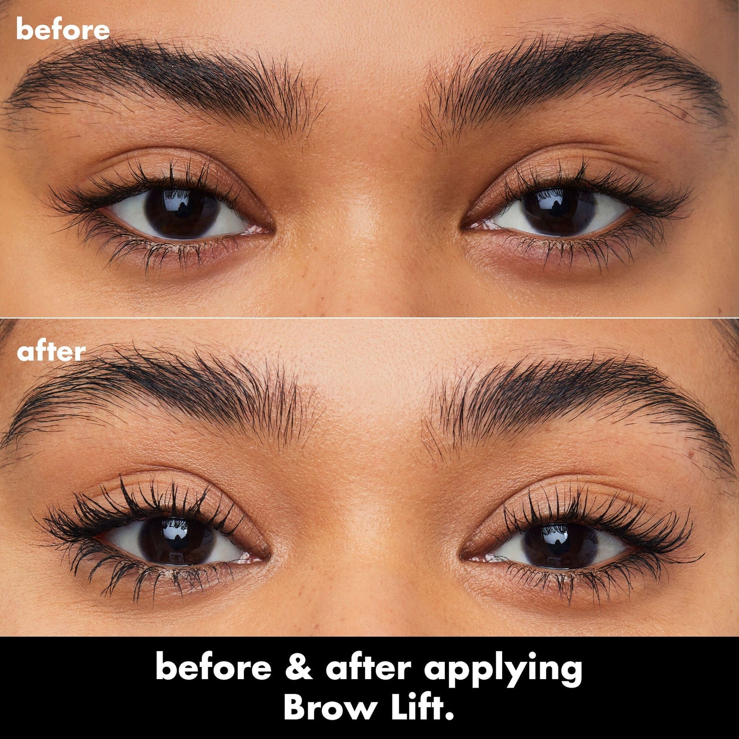 brow-lift-b4 0326_EDU_BrowLift_BA.jpg