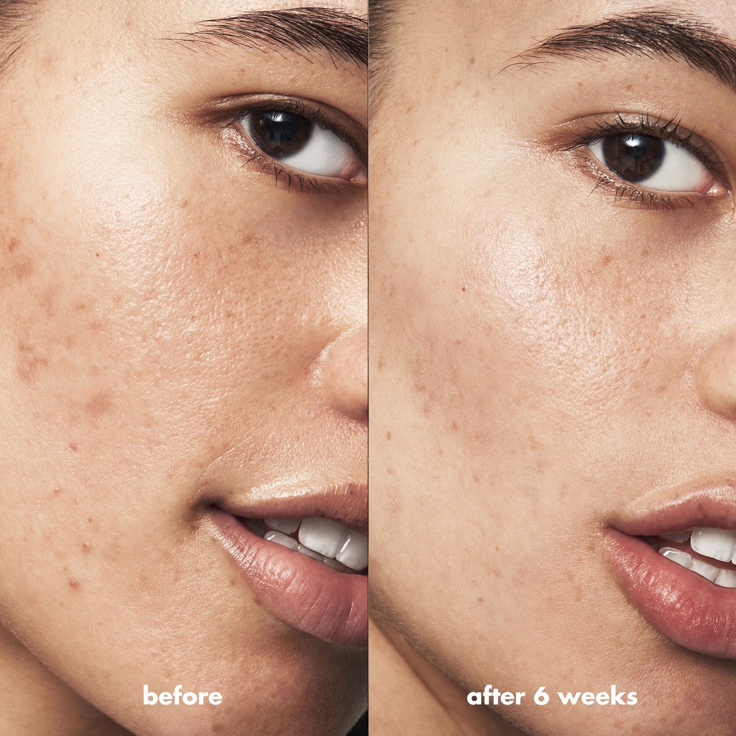blemish-breakthrough-acne-calming-water-cream-o2 Acne_PDP_Isabella_Before_After_84ce713a-22d2-4bb9-aad7-445c7b27b1c9.jpg