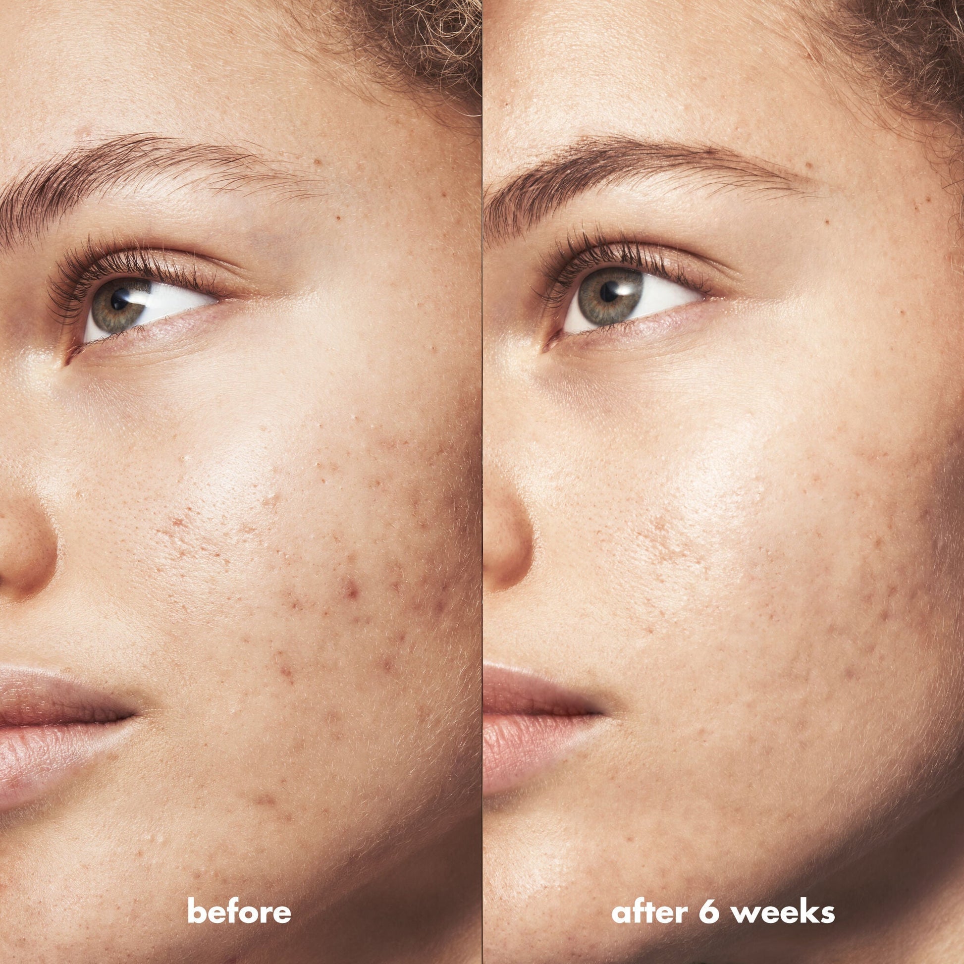 blemish-breakthrough-blemish-control-basics-kit-r0 Acne_PDP_Marley_Before_After_295728d2-6728-4f48-b8ef-c82bbca5b591.jpg